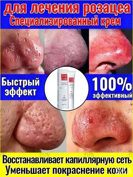 Эксклюзивный крем против розацеа и расширенных капилляров, 30 г, расширение сосудов и жирная кожа, одновремен