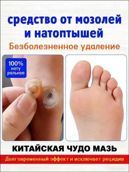 Гель Корнекс от стержневых мозолей и натоптышей лучшее средство от сухих мозолей, бородавок и папиллом