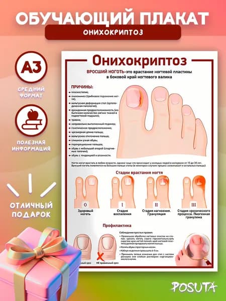 Постеры обучающие для подолога Онихокриптоз