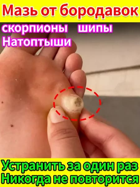 Эффективное удаление бородавок на стопе и мозолей снимает боль и восстанавливает здоровье кожи