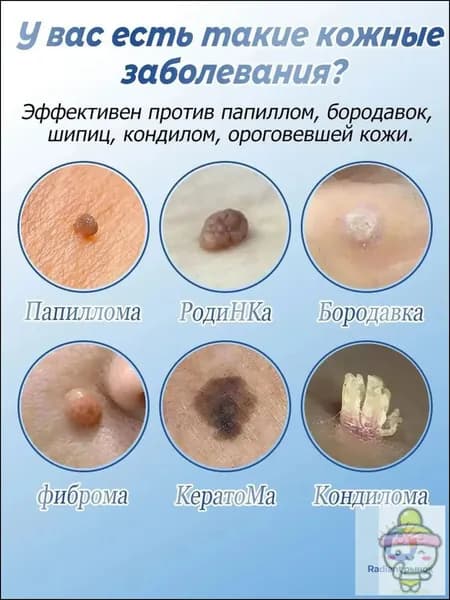 Популярное средство для избавления от новообразований, бесследно устраняющее папилломы, родинки и бородавки, без шрамов и нежелательных реакций, 20 г