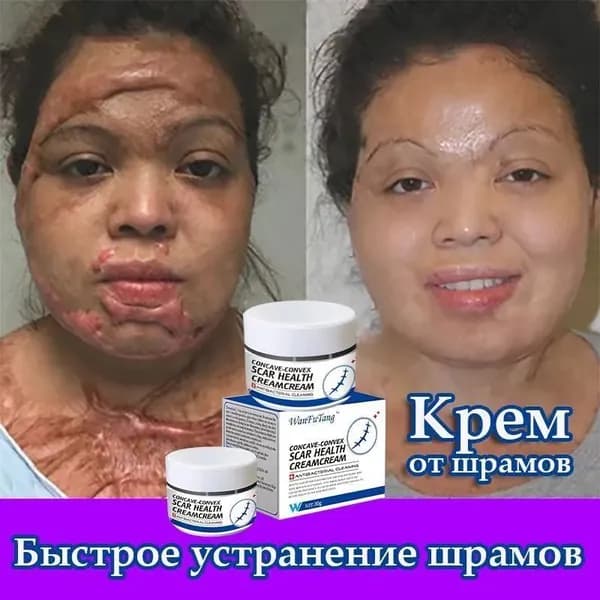 Заживляющий крем от шрамов, растяжки, ожогов, постакне 30 г