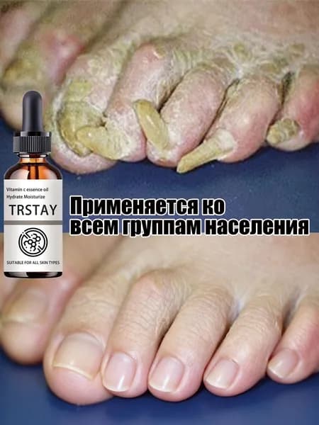 TRSTAY Масло-ессенция для ухода за ногтями (с витамином C): Эссенция для ногтей с витамином C глубокое увлажнение, универсально для всех типов кожи