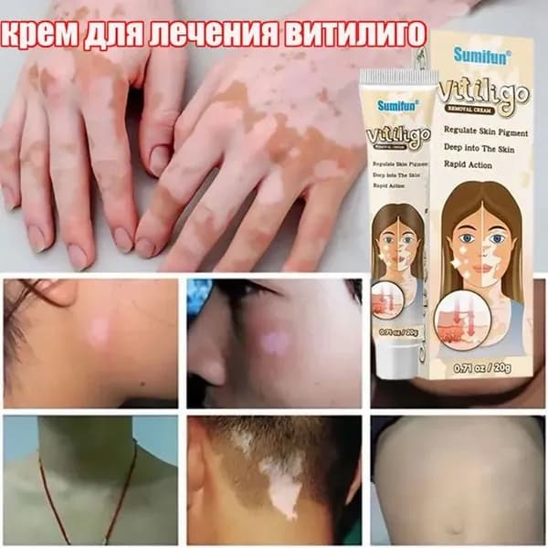 Крем от витилиго,белых пятен 20 г,для усиления пигментации при витилиго лейкодерма, лишай, бурые пятна
