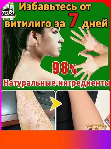 Мазь от витилиго,Средство при нежелательной пигментации витилиго.20 мл
