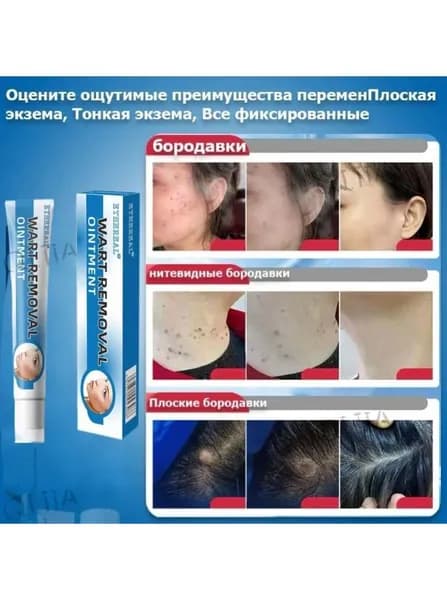 ETHEREALСредство для удаления бородавок, мозолей, папиллом и кондилом без следов, 20 г, 1 шт