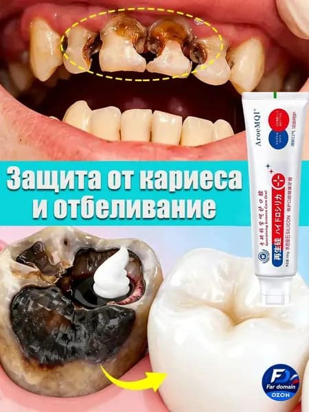 Зубная паста для дырки в зубе, глубокого кариеса и пульпита, Снимает боль, восстанавливает при поражении кариесом у взрослых, Свежее дыхание, 100 г, 1 шт.