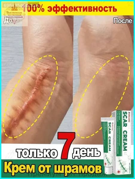 Крем от шрамов и рубцов, гель от прыщей на лице, мазь против ожогов и пигментных пятен и теле, средство от постакне30 г