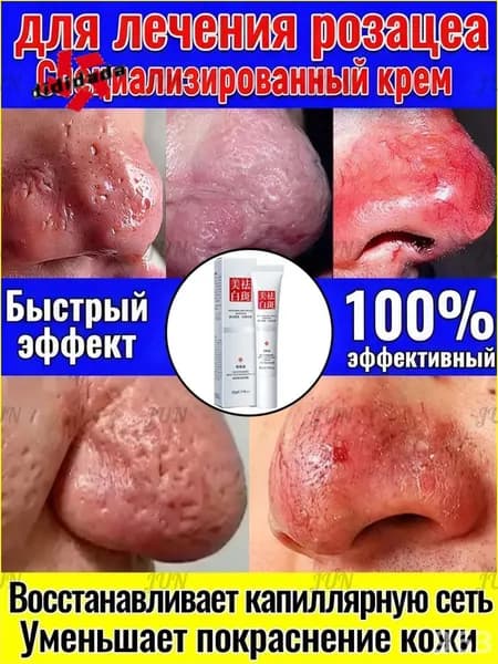 Эксклюзивный крем против розацеа и расширенных капилляров, 30 г, расширение сосудов и жирная кожа, одновремен