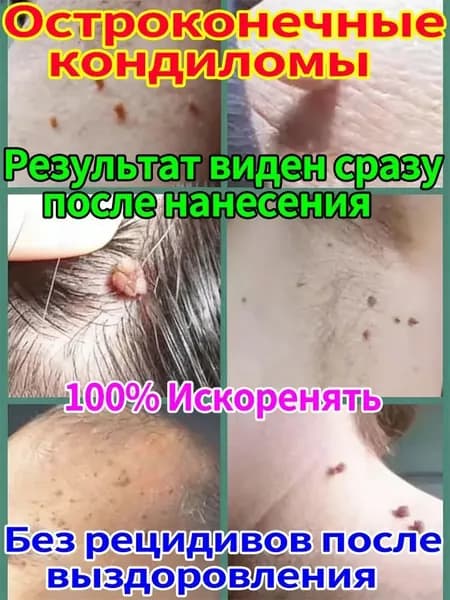 Лекарство от папиллом и бородавок, эффективно удаляет бородавки и папилломы, кондиломы с лица и тела, не оставляя шрамов, 20 гм