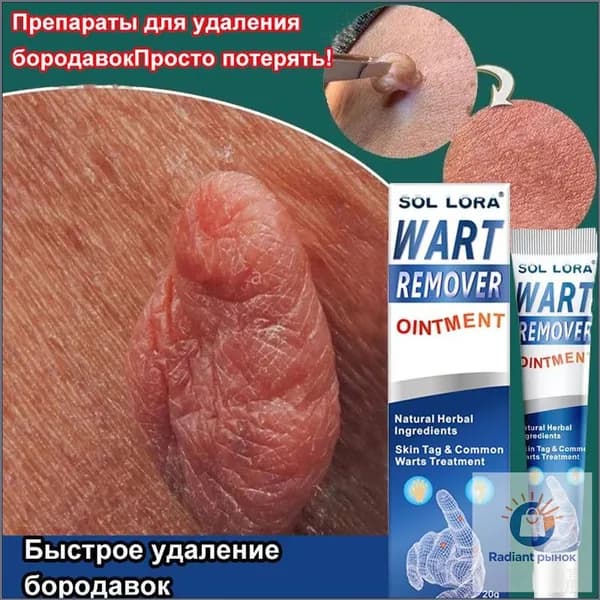 Качественный крем для безболезненного удаления бородавок, папиллом и родинок, не оставляющий следов и побочных эффектов, объем 20 грамм