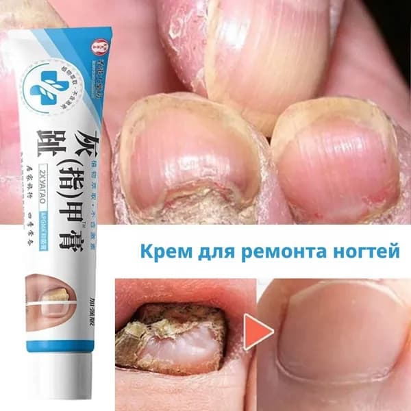 Противогрибковый крем от грибка ногтей на ногах