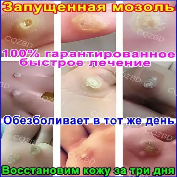 Мазь от шипиц, подошвенных и ладонно-подошвенных бородавок, натоптышей и мозолей на ногах - эффективное удаление и лечение для женщин и мужчин.ингредиенты китайской медицины.