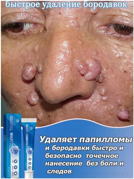 Эксклюзивный крем для удаления папиллом, бородавок и родинок на руках, ногах и лице, созданный на основе растительных экстрактов, 20 г