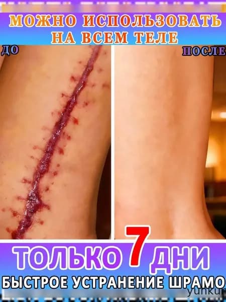 Крем для удаления шрамов. Быстро удаляет шрамы, растяжки, ожоги, рубцы от угревой сыпи и пигментацию. Подходит для любой части тела. 30 грамм.