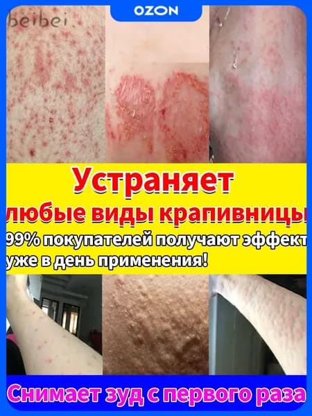 Мазь от крапивницы для взрослых и детей: быстрое снятие зуда, отека и сыпи на коже. Комплексное лечение всех в