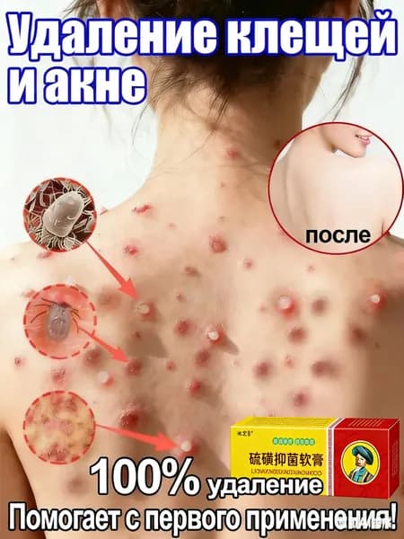 Крем от акне на спине и клещей: эффективное лечение прыщей, угрей и кожных проблем, для здоровой кожи спины