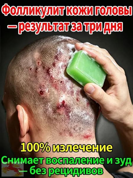 Лечебное мыло от фолликулита кожи головы противогрибковое натуральное снимает зуд и воспаление быстрый результат