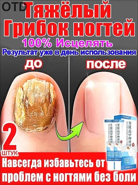 2 штуки,крем ноготок от грибка ногтей на ногах,ноготок мазь от грибка на ногах,гиперкератоз