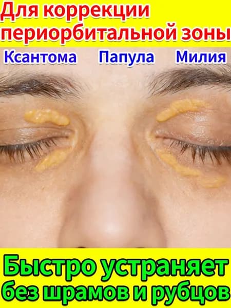 Мазь для лечения халязиона, удаления милиумов на веке и ксантелазмы комплексный уход за кожей вокруг глаз