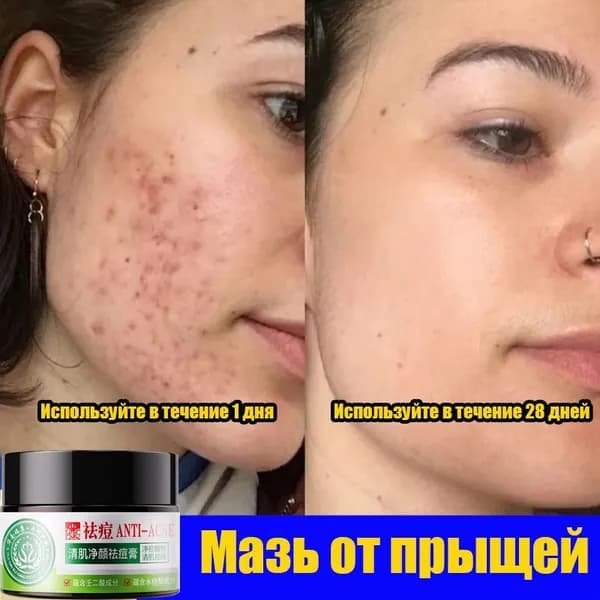 Мазь для удаления угревой сыпи, противовоспалительная, 30 грамм