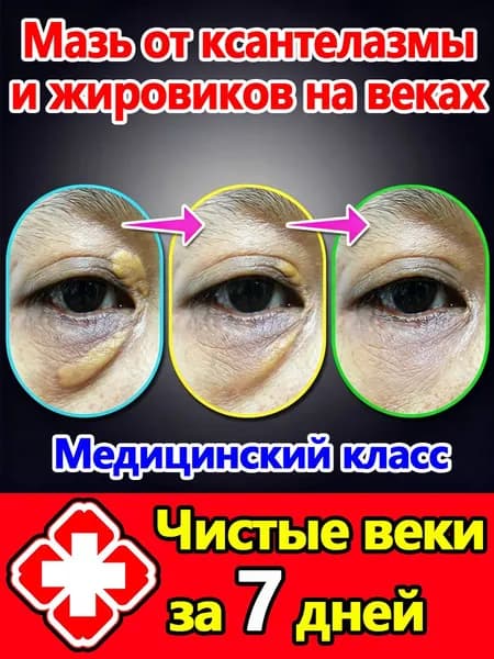 Средство от ксантелазмы без операции: уход за кожей век