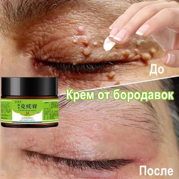 Крем для удаления бородавок и родинок 20g от папиллом и бородавок на проблемной коже лица