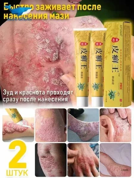 Мазь от псориаза экземы и грибка ногтей на ногах