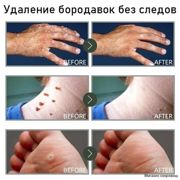 Крем от бородавок и папиллом для удаления родинок и кожных наростов без боли с чистотелом
