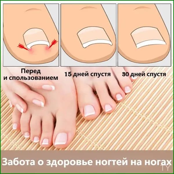 Премиум пластины от вросших ногтей