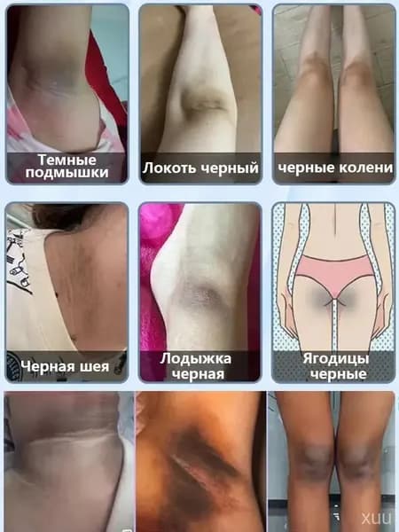 Крем для отбеливания подмышек 50 г с коевой кислотой 1 шт