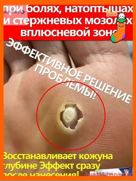 Скидка сегодняпри болях, шишках и в плюсневой зоне, от стержневых шишек 20 г
