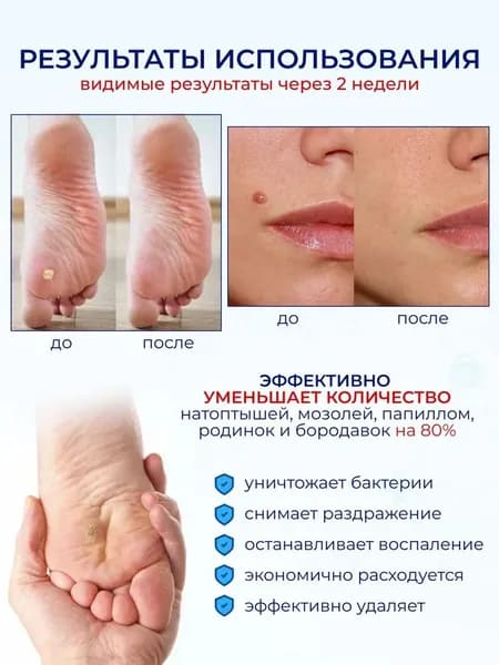 Для удаления бородавок, для ухода за бородавками, папилломами и родинками, щадящее действие, безболезненно и быстро, 3 мл