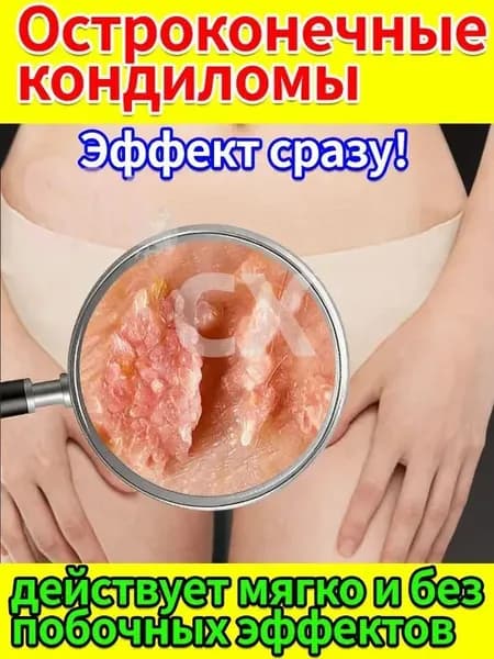 Крем для удаления остроконечных кондилом у женщин и мужчин. Лечение кондилом, папиллом и ВПЧ в интимной зоне и на коже. Средство от генитальных бородавок