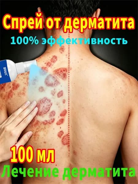 Спрей от псориаза Негормональный спрей для лечения псориаза, дерматита и экземы, порезов, противозудный, 100 мл.