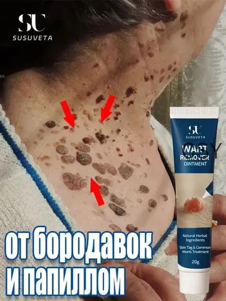 Средство от бородавок и папиллом для рук и лица, 20 г. Быстрое и безболезненное удаление.