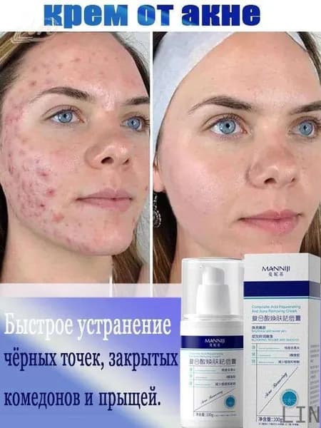 Крем для лица и тела против акне, помогает снять воспаление и убрать прыщи. Объем 100 г.LIN