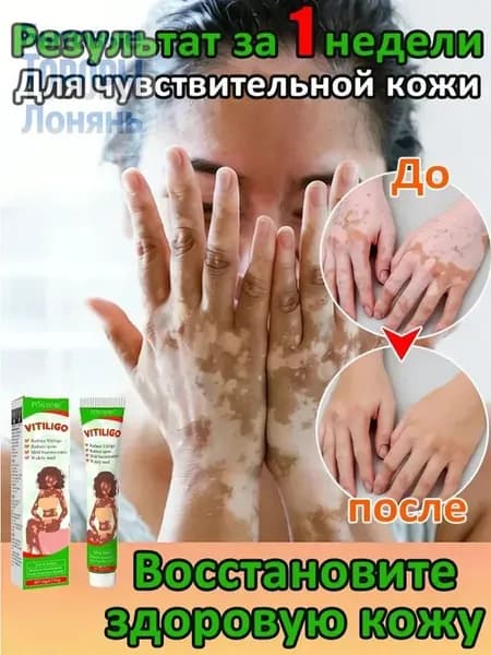 Мазь от витилиго,Средство при нежелательной пигментации витилиго.20 мл