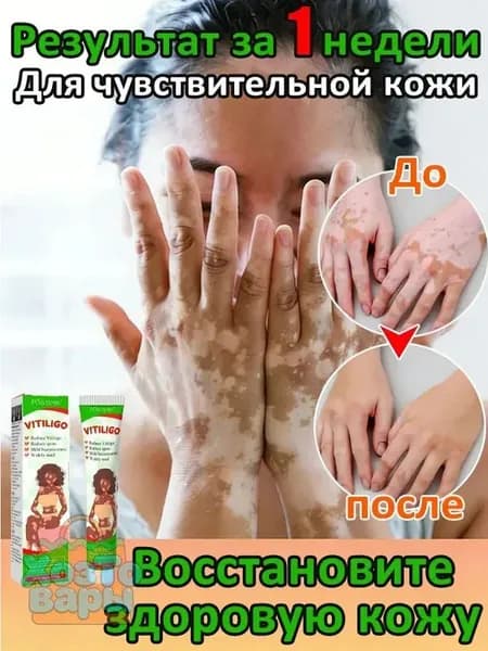 Мазь от витилиго,Средство при нежелательной пигментации витилиго.100 мл