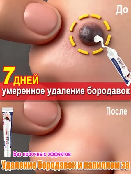 Крем от папиллом и бородавок, средство для удаления новообразований, чистотел, Китайская травяная мазь,отсутствие побочных эффектов 20г