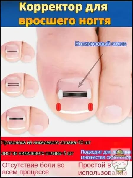 Комплект из 10+5 никелид-титановых корректоров для вросших ногтей