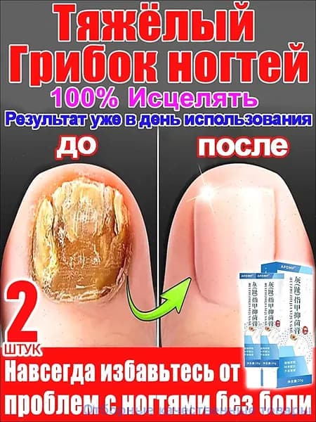 2 штуки,крем ноготок от грибка ногтей на ногах,ноготок мазь от грибка на ногах,гиперкератоз