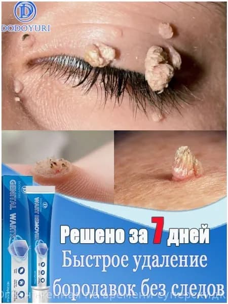 Качественный состав с экстрактом растений включён в крем, используемый для удаления папиллом, родинок и бородавок на руках, лице и ногах, 20 г