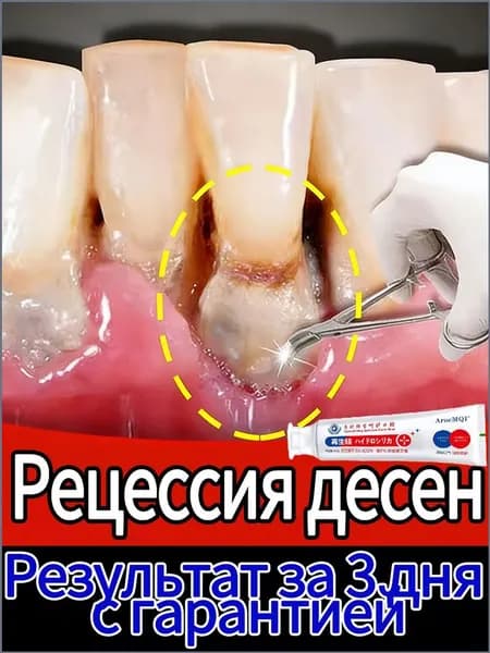 Восстановление десен и укрепление зубов при рецессии - гель с регенерирующим кремнием