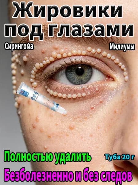 Удаление милиумов под глазами и на веках Быстрое избавление от жировых гранул.