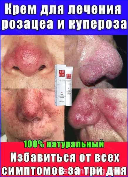 Крем для лица от купероза, розацеа, покраснений "Тонус-Капилляр Лица".для проблемной кожи,100% натуральный В безгормональном составе.20 мл