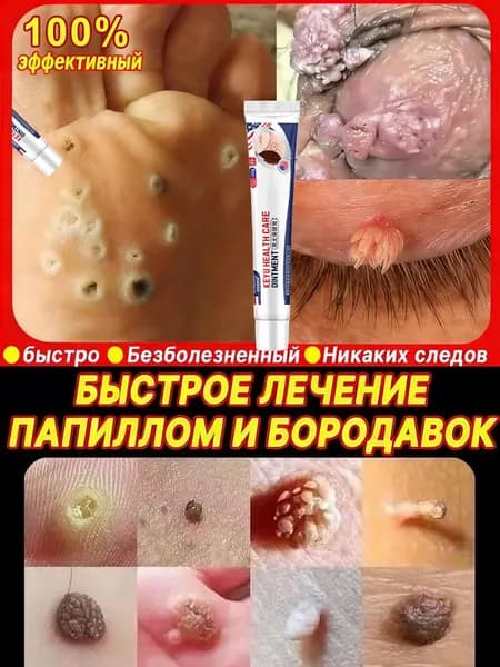 крем-средство от папиллом, лечение бородавок, удаление родинок, безболезненный, не оставляет следов, кожа становится гладкой и увлажненной