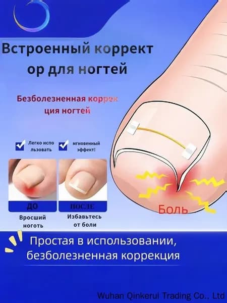 Набор для коррекции вросшего ногтя из никель-титанового спла…
