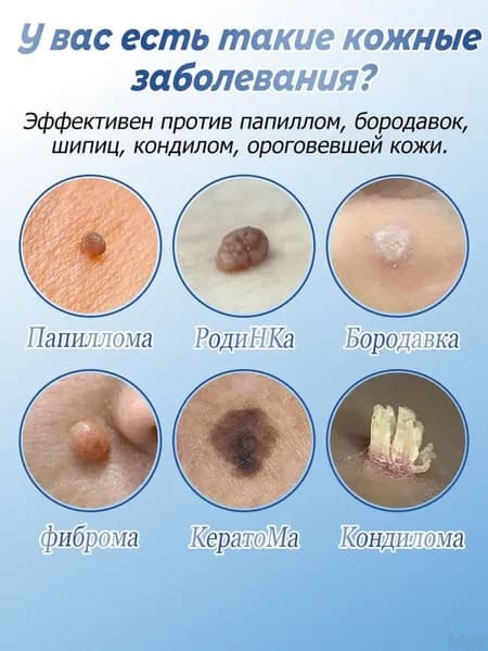 Крем от бородавок, который безболезненно удаляет бородавки, папилломы и родинки, не оставляя шрамов и побочных эффектов. 20 г
