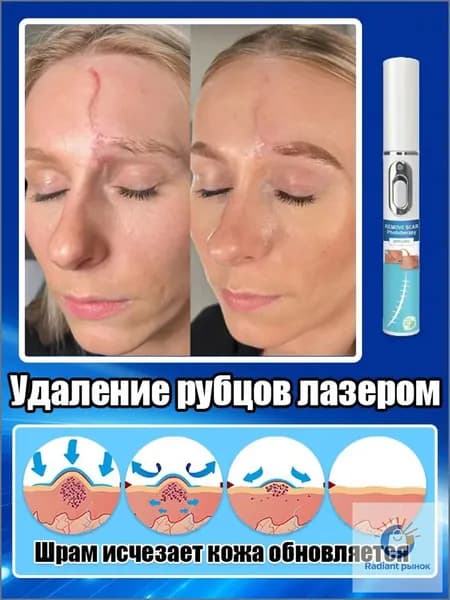 Лазерная ручка для удаления шрамов, используемая для удаления шрамов, растяжек, травм и пигментации, устранения рубцов, восстановления гладкости кожи и быстрого заживления. одна лазерная ручка